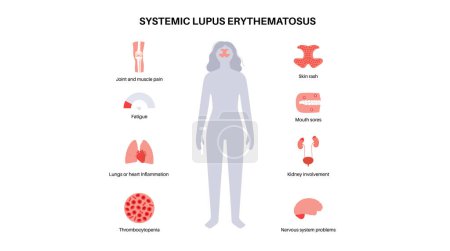 Systemischer Lupus erythematodes medizinisches Poster. Schmetterlings- oder Malarenausschlag auf einem weiblichen Gesicht. Autoimmunkrankheit. Entzündungen und Schädigungen des Hautgewebes, Schmerzen in den inneren Organen Vektor Illustration