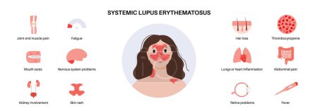 Lupus érythémateux systémique affiche médicale. Éruption papillon ou malaire sur le visage d'une femme. Concept de maladie auto-immune. Inflammation et lésions des tissus cutanés, douleur dans les organes internes illustration vectorielle