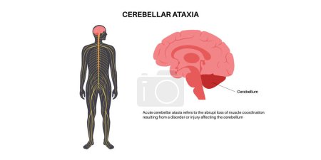 Cerebellar ataxia medical poster. Degenerative disease of the nervous system. Slurred speech, stumbling, falling, lack of coordination. Poor muscle control, clumsy movements flat vector illustration