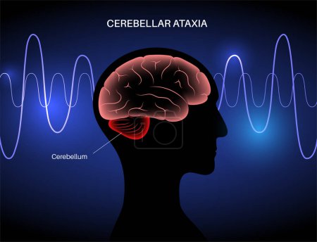 Illustration for Cerebellar ataxia medical poster. Degenerative disease of the nervous system. Slurred speech, stumbling, falling, lack of coordination. Poor muscle control, clumsy movements flat vector illustration - Royalty Free Image