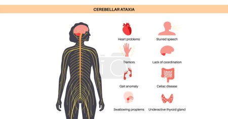 Illustration for Cerebellar ataxia poster. Degenerative disease of the nervous system, main symptoms. Slurred speech, stumbling, falling, lack of coordination. Poor muscle control, clumsy movements vector illustration - Royalty Free Image