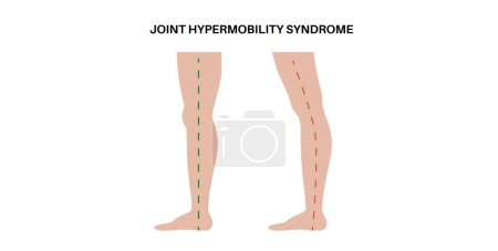 Síndrome de hipermovilidad articular o trastorno del espectro de hipermovilidad. Amplio rango anormal de movimiento en las piernas humanas. Piel y extremidades elásticas y elásticas en el cuerpo humano ilustración de vectores planos médicos