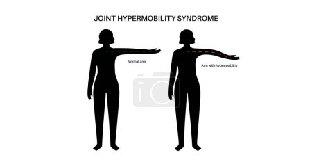 Syndrome d'hypermobilité articulaire ou trouble du spectre d'hypermobilité. Large amplitude anormale de mouvement dans les bras humains. Peau et membres élastiques et extensibles dans le corps humain illustration vectorielle plate médicale