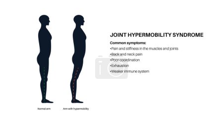 Gelenkhypermobilitätssyndrom oder Störung des Hypermobilitätsspektrums. Abnormal großer Bewegungsbereich in menschlichen Beinen. Elastische und dehnbare Haut und Gliedmaßen im menschlichen Körper medizinische Flachvektorillustration