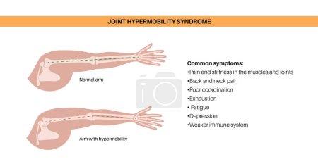 Joint hypermobility syndrome or hypermobility spectrum disorder. Abnormal large range of movement in human arms. Elastic, and stretchy skin and limbs in the human body medical flat vector illustration