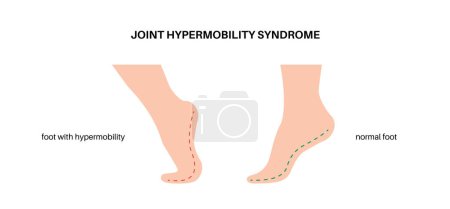 Illustration for Joint hypermobility syndrome or hypermobility spectrum disorder. Abnormal large range of movement in human legs. Elastic, and stretchy skin and limbs in the human body medical flat vector illustration - Royalty Free Image
