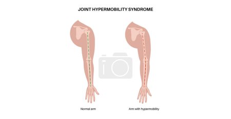 Síndrome de hipermovilidad articular o trastorno del espectro de hipermovilidad. Amplio rango anormal de movimiento en brazos humanos. Piel y extremidades elásticas y elásticas en el cuerpo humano ilustración de vectores planos médicos