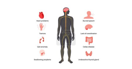 Kleinhirnataxie-Poster. Degenerative Erkrankung des Nervensystems, Hauptsymptome. Sprachstörungen, Stolpern, Stürzen, mangelnde Koordination. Schlechte Muskelkontrolle, unbeholfene Bewegungsabläufe