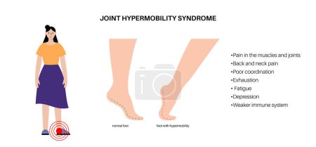 Ilustración de Síndrome de hipermovilidad articular o trastorno del espectro de hipermovilidad. Amplio rango anormal de movimiento en las piernas humanas. Piel y extremidades elásticas y elásticas en el cuerpo humano ilustración de vectores planos médicos - Imagen libre de derechos