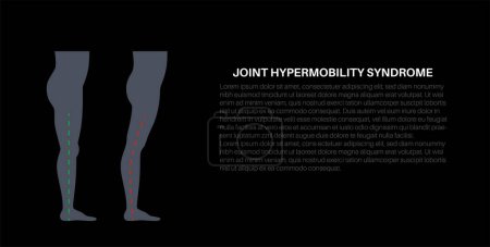 Ilustración de Síndrome de hipermovilidad articular o trastorno del espectro de hipermovilidad. Amplio rango anormal de movimiento en las piernas humanas. Piel y extremidades elásticas y elásticas en el cuerpo humano ilustración de vectores planos médicos - Imagen libre de derechos