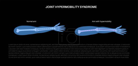 Joint hypermobility syndrome or hypermobility spectrum disorder. Abnormal large range of movement in human arms. Elastic, and stretchy skin and limbs in the human body medical flat vector illustration