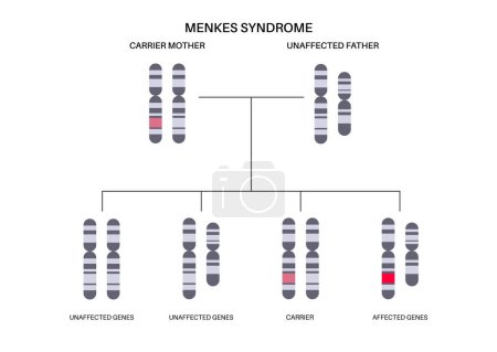 Ilustración de Menkes syndrome, genetic slow development disease pattern. Joint bones and internal organs problem. Child inherits one copy of a mutated gene from each parent. Affected, carriers or healthy chromosome - Imagen libre de derechos
