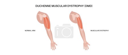 Duchenne muscular dystrophy inheritance medical poster. Hereditary neuromuscular disease. Progressive muscle fiber degeneration and weakness. Genetic mutation in human body flat vector illustration