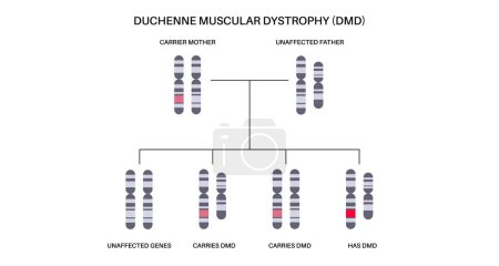 Duchenne muscular dystrophy inheritance pattern. Hereditary neuromuscular disease. Progressive muscle fiber degeneration and weakness. Affected, carriers or healthy chromosomes vector illustration.