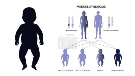 Ilustración de Menkes syndrome, genetic slow development disease pattern. Joint bones and internal organs problem. Child inherits one copy of a mutated gene from each parent. Affected, carriers or healthy chromosome - Imagen libre de derechos