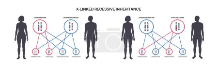 Illustration for X linked recessive inheritance pattern. Child inherits one copy of a mutated gene from each parent. Genetic disease or disorder. Affected, carriers or healthy X and Y chromosomes vector illustration. - Royalty Free Image