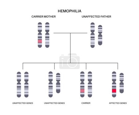 Hemophilia, X linked genetic disease. Inherited bleeding disorder. Blood does not clot properly. Child inherits one copy of a mutated gene from each parent. Affected, carriers or healthy chromosomes