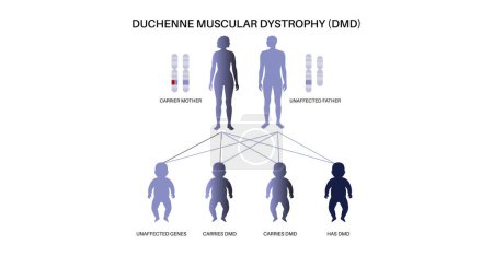 Duchenne Muskeldystrophie Vererbungsmuster. Erbliche neuromuskuläre Erkrankung. Progressive Muskelfaserdegeneration und Schwäche. Betroffene, Träger oder gesunde Chromosomen-Vektorabbildung.