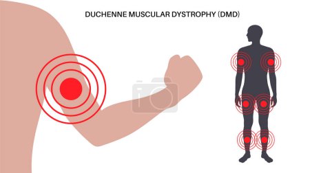 Duchenne muscular dystrophy inheritance medical poster. Hereditary neuromuscular disease. Progressive muscle fiber degeneration and weakness. Genetic mutation in human body flat vector illustration