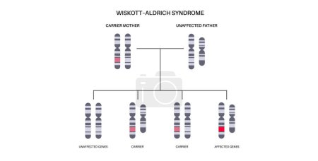 Illustration for Wiskott Aldrich syndrome. X linked genetic immunodeficiency. Immune system disease in males. Child inherits one copy of a mutated gene from each parent. Affected, carriers or healthy chromosomes - Royalty Free Image