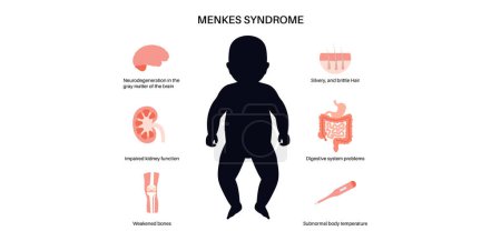 Menkes syndrome, genetic slow development disease poster. Joint bones and internal organs problem. Child inherits one copy of a mutated gene from each parent. Affected, carriers or healthy chromosome