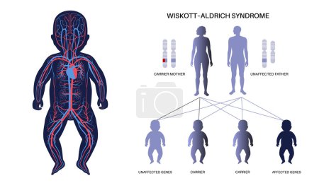 Wiskott Aldrich syndrome. X linked genetic immunodeficiency. Immune system disease in males. Child inherits one copy of a mutated gene from each parent. Affected, carriers or healthy chromosomes