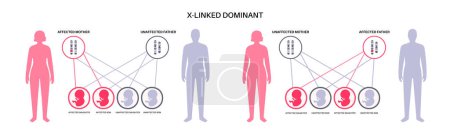 X schéma d'héritage dominant lié. L'enfant hérite d'une copie d'un gène muté de chaque parent. Maladie ou trouble génétique. Illustration vectorielle des chromosomes X et Y affectés, porteurs ou en bonne santé.