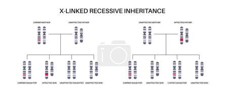 Ilustración de X linked recessive inheritance pattern. Child inherits one copy of a mutated gene from each parent. Genetic disease or disorder. Affected, carriers or healthy X and Y chromosomes vector illustration. - Imagen libre de derechos