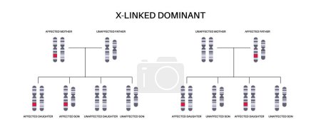 Illustration for X linked dominant inheritance pattern. Child inherits one copy of a mutated gene from each parent. Genetic disease or disorder. Affected, carriers or healthy X and Y chromosomes vector illustration. - Royalty Free Image