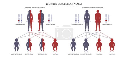 Patrón de ataxia cerebelosa ligada al X. El niño hereda una copia de un gen mutado de cada padre. Infografía de enfermedades genéticas. Afectados, portadores o cromosomas X e Y sanos ilustración vectorial.