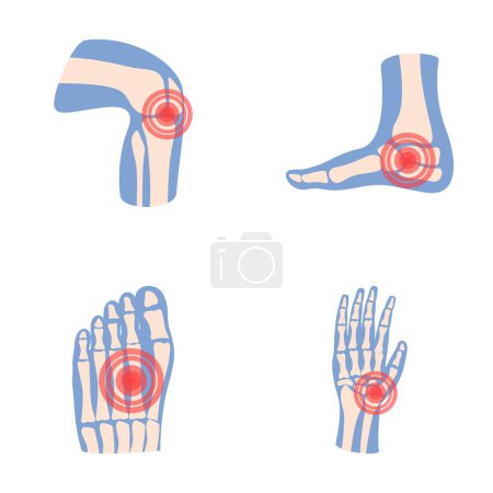 Téléchargez les illustrations : Icônes de l'arthrite définir vecteur de dessin animé. Joint humain avec anneau douloureux. Rhumatologie, médecine - en licence libre de droit