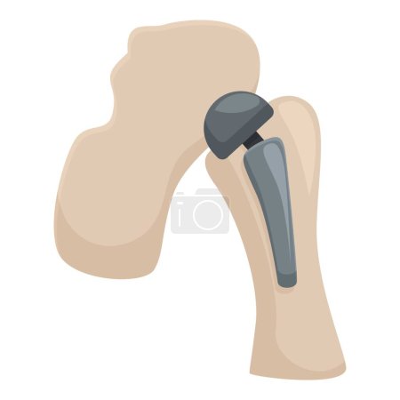 Vector graphic of a hip joint replacement, showcasing a medical prosthetic implant