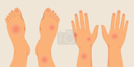 Human legs and hands covered with red rash.
