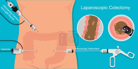 Laparoscopic colectomy surgery is inserted into the abdomen to remove the cancerous parts of the colon.The advantages of laparoscopic colectomy