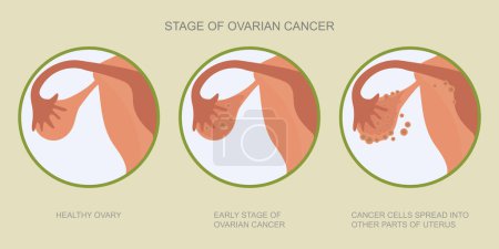 Ovarian cancer refers to any cancerous growth.
