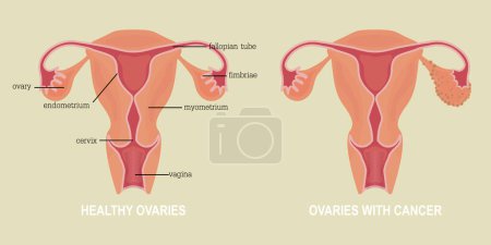 Cancer de l'ovaire désigne toute croissance cancéreuse qui commence dans les ovaires.