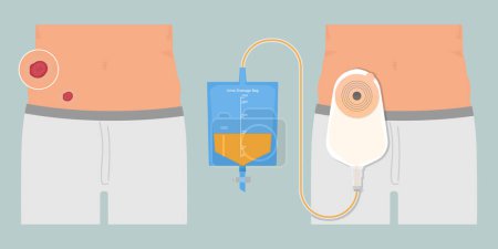 Illustration for Stoma and colostomy isolated on background. - Royalty Free Image