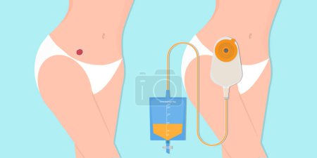 Illustration for Stoma and colostomy isolated on background. - Royalty Free Image