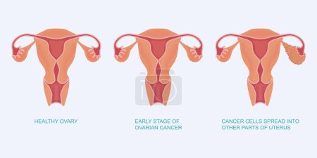Stage of ovarian cancer.