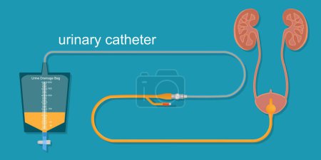 Illustration for Urinary catheter in the body. - Royalty Free Image