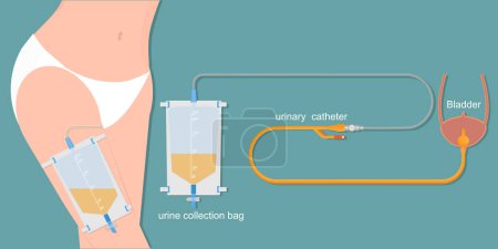 Urinary catheter in the female body with urinary leg bag.