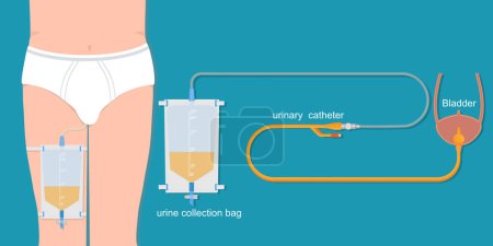 Catéter urinario en el cuerpo masculino con bolsa de pierna urinaria.
