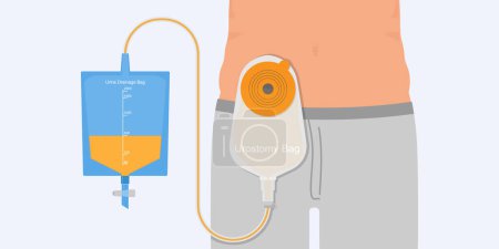 Illustration for Urostomy bag containing urine flow through small bowel stoma. - Royalty Free Image