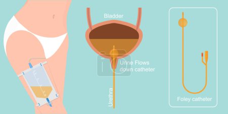 El catéter urinario es un tubo flexible utilizado para vaciar la vejiga..