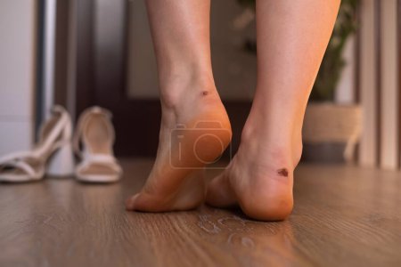 Primer plano de los pies femeninos con callos, zapatos incómodos y plantillas ortopédicas.