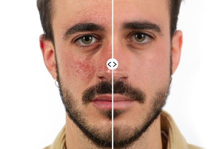 Cara masculina caucásica con rosácea de piel roja antes y después del tratamiento con cuperosa