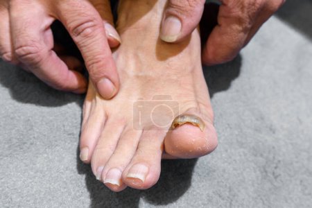 Widok z bliska człowieka boso z żółtym i grubym dużym paznokciem u nóg, onychomycosis, grzybicze zakażenie paznokci u nóg.