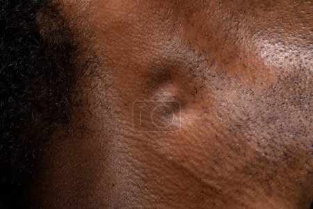Téléchargez les photos : Macro des ganglions lymphatiques enflés dans le cou d'un homme africain, réponse immunitaire du système lymphatique ou possibilité de tumeur maligne - en image libre de droit