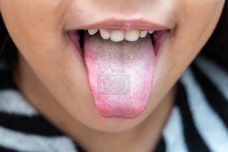 Nahaufnahme der Zunge eines kleinen Mädchens mit bakterieller Patina aufgrund mangelnder Mundhygiene oder schlechter Ernährung.
