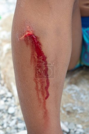 Photo for Bleeding wound on a child's leg. Concept of traumatic falls while playing in the childhood age. - Royalty Free Image